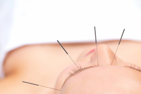 شفاف سازی پوست با کاشت نخ و طب سوزنی