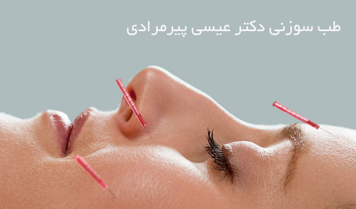 زیبایی با طب سوزنی