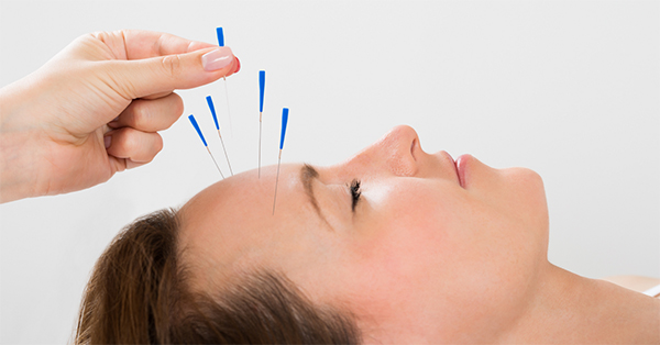 Treatment of migraine with acupuncture 1