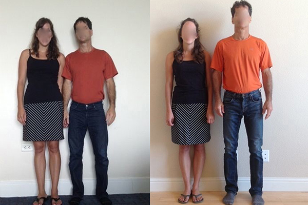 افزایش قد با کاشت نخ و طب سوزنی