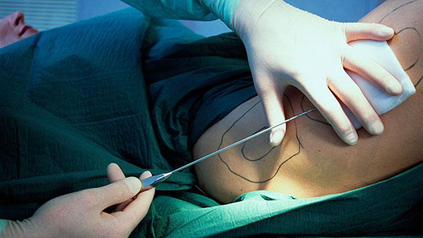 تفاوت میان مزوتراپی لاغری شکم با لیپوساکشن