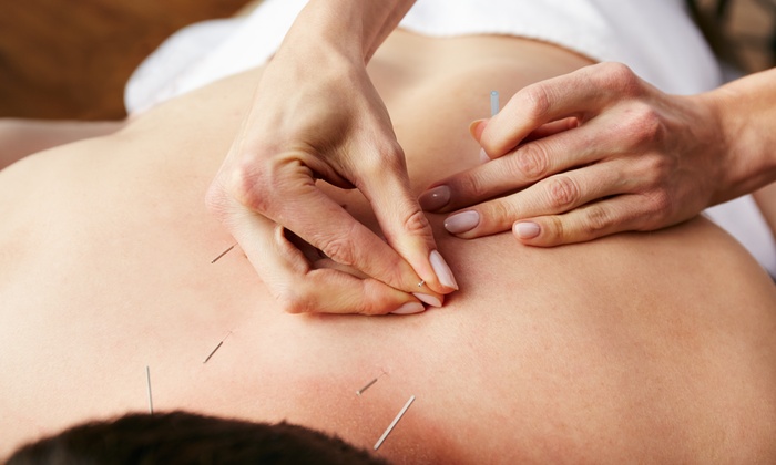 امبدینگ کاشت نخ طب سوزنی